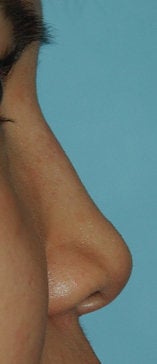 Non Surgical Rhinoplasty