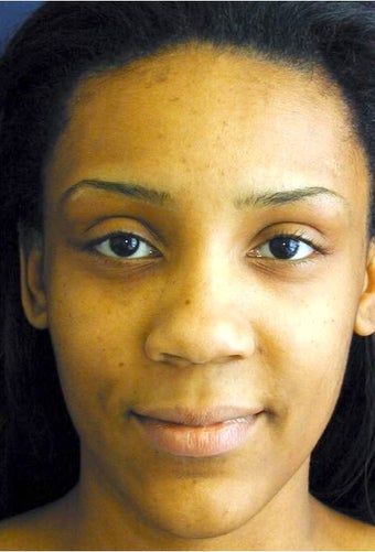 Ethnic Rhinoplasty