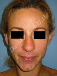 Rhinoplasty