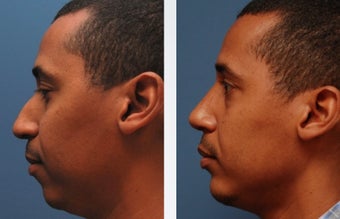 Rhinoplasty