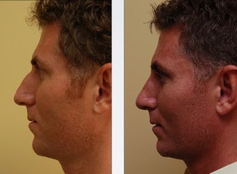 Rhinoplasty