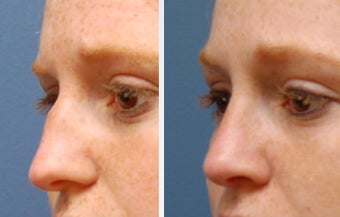 Rhinoplasty