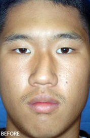 Rhinoplasty