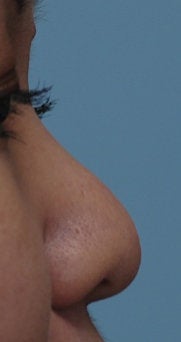 Non Surgical Rhinoplasty