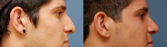 Rhinoplasty, Ethnic Iranian