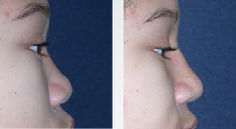 Rhinoplasty