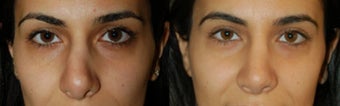 Ethnic Rhinoplasty