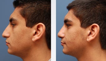 Rhinoplasty
