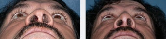 Hispanic Rhinoplasty