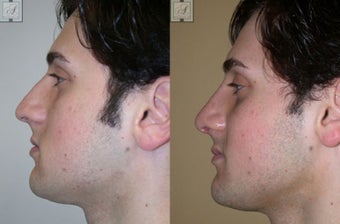 Primary Rhinoplasty