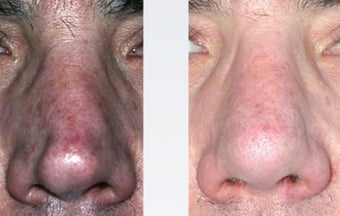 Rhinoplasty Nasal Reconstruction