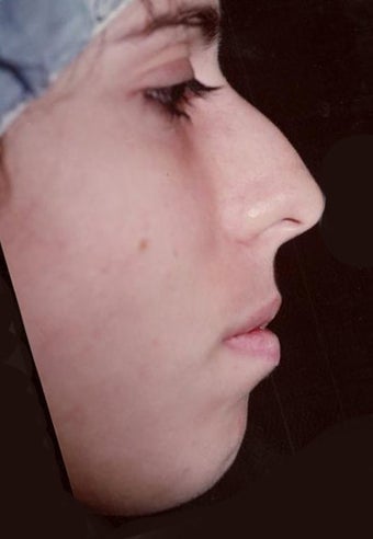 Rhinoplasty