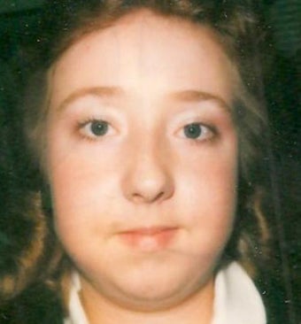 Rhinoplasty