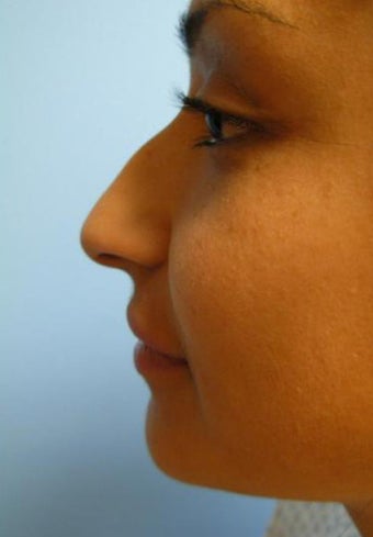 Rhinoplasty