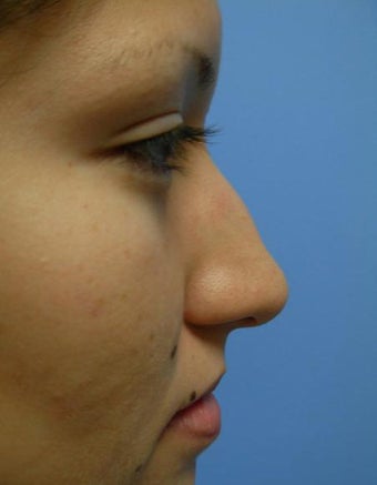 Rhinoplasty