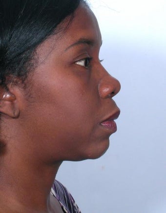 Rhinoplasty