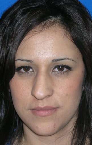 Rhinoplasty