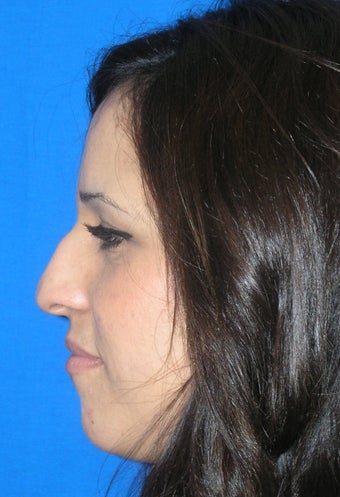 Rhinoplasty