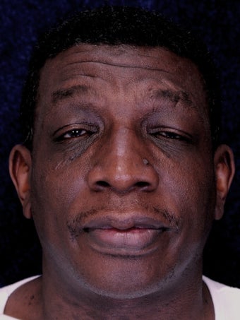 Rhinoplasty