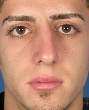 Rhinoplasty