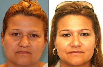Reduction Rhinoplasty