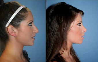 primary rhinoplasty
