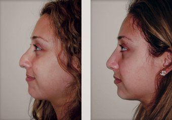 Rhinoplasty