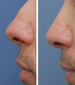 Rhinoplasty