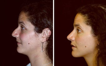 28 year old female, rhinoplasty