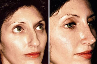 25 year old female, rhinoplasty
