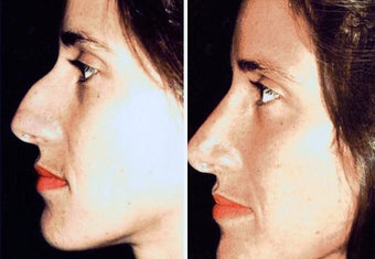 38 year old female, rhinoplasty