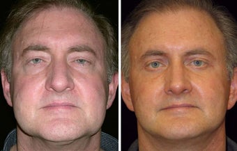 55 year old male, rhinoplasty