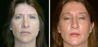 45 year old female, rhinoplasty