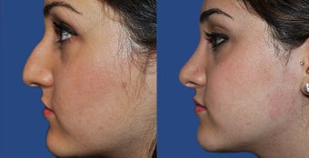 Rhinoplasty