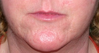 Vbeam for rosacea