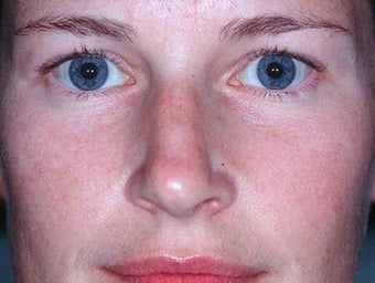 Laser treatment for rosacea 