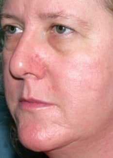 PDL for rosacea 