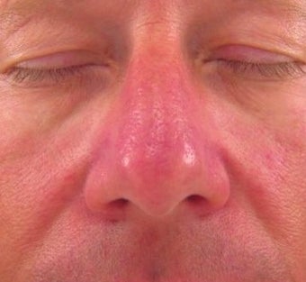 Vbeam for Rosacea Treatment