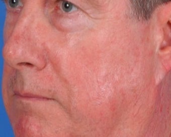 Vbeam laser rosacea treatment