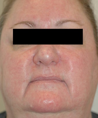 Rosacea Laser Treatment Los Angeles Before and After Pictures