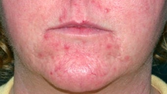 Vbeam for rosacea