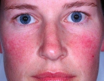 Laser treatment for rosacea 