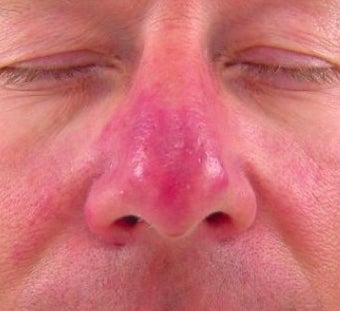 Vbeam for Rosacea Treatment