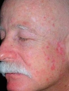 PDT for rosacea