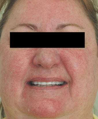 Rosacea Laser Treatment Los Angeles Before and After Pictures