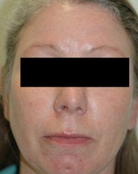 Laser Treatments for Rosacea
