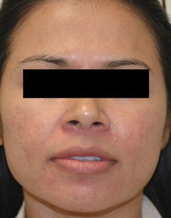 Rosacea Treatment with Lasers