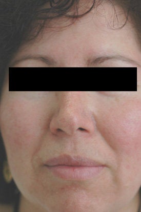 Laser Treatments for Rosacea