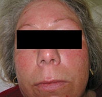 Laser Treatments for Rosacea