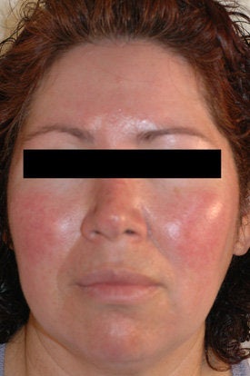 Laser Treatments for Rosacea